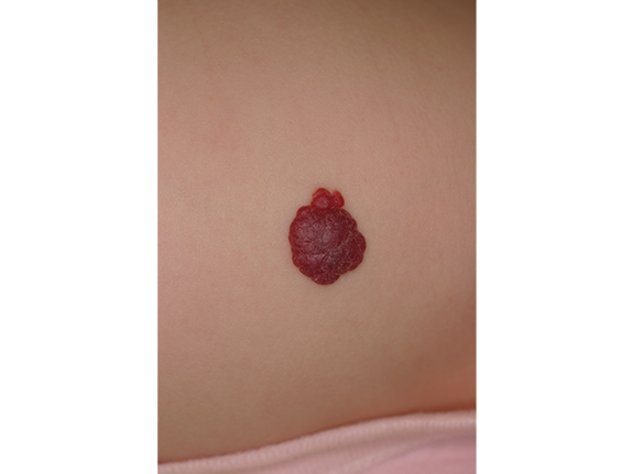 写真：乳児血管腫のイメージ