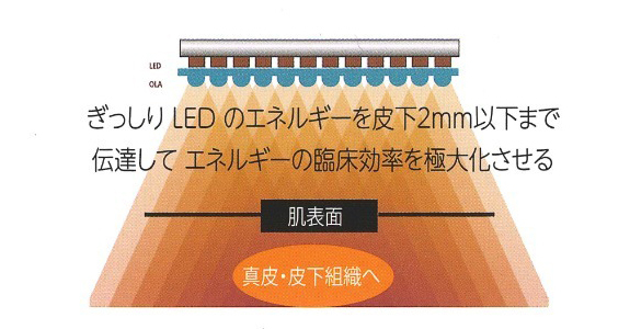 医療用新世代LEDヒーライトⅡとは？